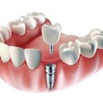 dental implant procedure