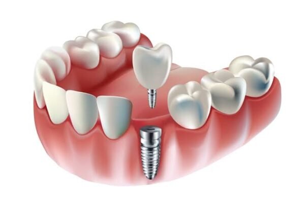 dental implant procedure