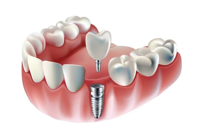 dental implant procedure